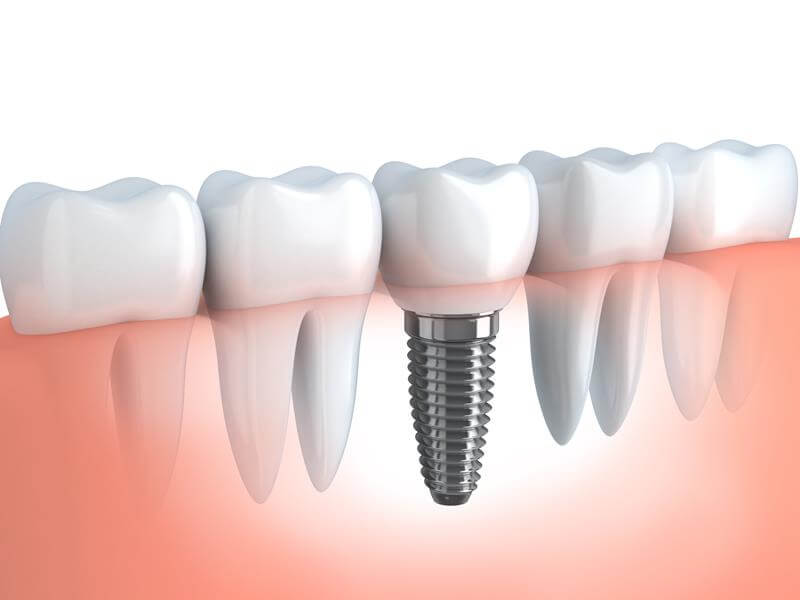 3d illustration of dental implant