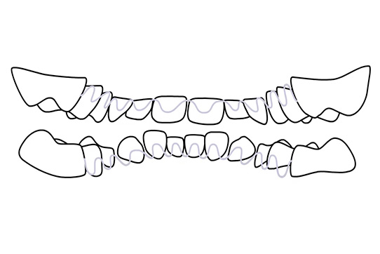 Image of model hidden braces