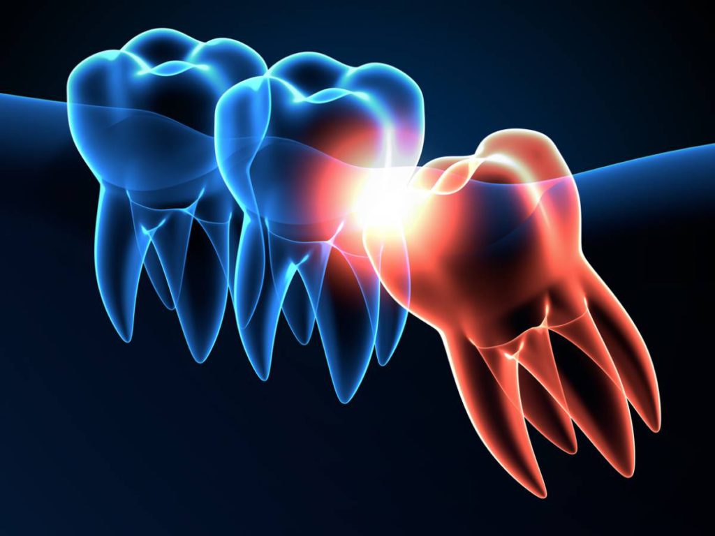 3d illustration of wisdom teeth causing problems from impaction.