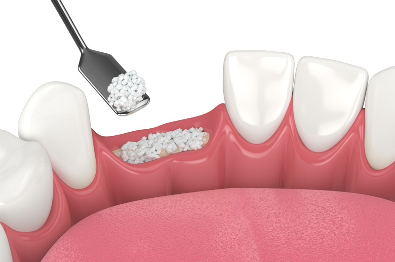 Bone grafting image